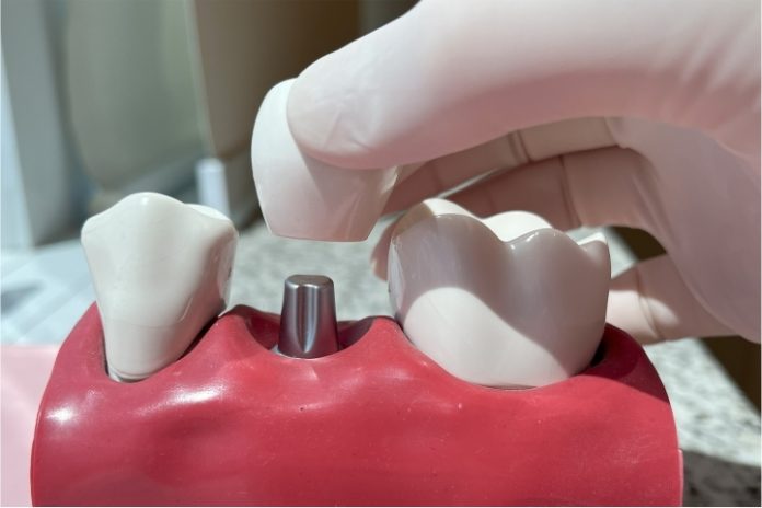 Cresce busca por implantes dentários com tecnologia digital